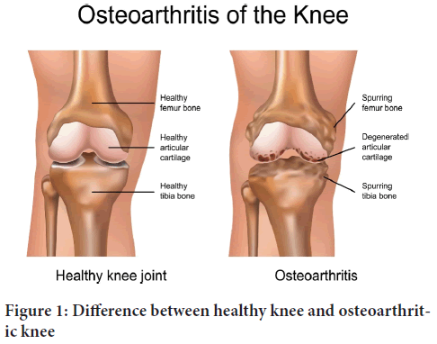 osteoarthritic