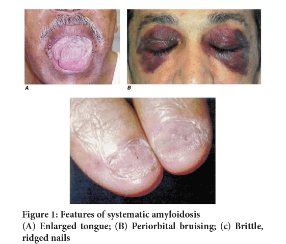 SRP-amyloidosis