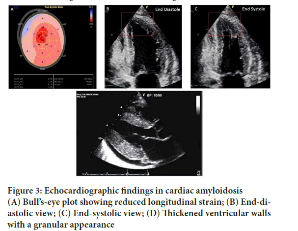 SRP-echocardiographic